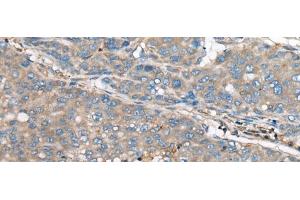 Immunohistochemistry of paraffin-embedded Human liver cancer tissue using GULP1 Polyclonal Antibody at dilution of 1:65(x200) (GULP1 抗体)