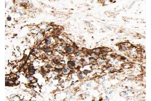 ABIN6268654 at 1/100 staining human liver carcinoma sections by IHC-P. (GJC1 抗体)