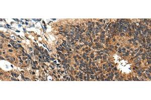 Immunohistochemistry of paraffin-embedded Human colorectal cancer tissue using BMPER Polyclonal Antibody at dilution of 1:40(x200) (BMPER 抗体)