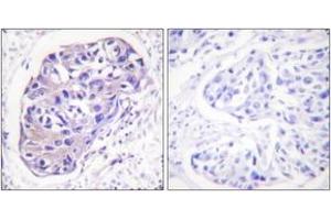 Immunohistochemistry analysis of paraffin-embedded human breast carcinoma tissue, using GRK2 (Ab-29) Antibody. (GRK2 抗体  (AA 14-63))