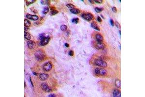 Immunohistochemical analysis of GBP4 staining in human lung cancer formalin fixed paraffin embedded tissue section. (GBP4 抗体  (C-Term))