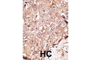 Formalin-fixed and paraffin-embedded human hepatocellular carcinoma tissue reacted with AOF2 polyclonal antibody , which was peroxidase-conjugated to the secondary antibody, followed by DAB staining. (LSD1 抗体  (C-Term))