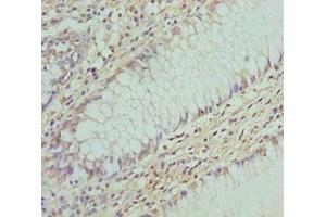 Immunohistochemistry of paraffin-embedded human colon cancer using ABIN7148460 at dilution of 1:100 (COG5 抗体  (AA 1-260))