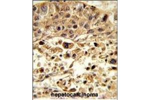 Formalin-fixed and paraffin-embedded human hepatocarcinoma reacted with VPS26A Antibody (Center), which was peroxidase-conjugated to the secondary antibody, followed by DAB staining. (VPS26A 抗体  (AA 263-291))