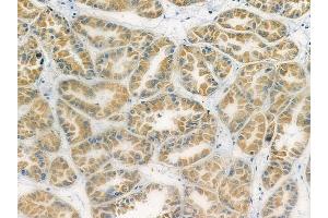 ABIN6259385 and ABIN6276150 at 1/100 staining human renal cell carcinoma by IHC-P.