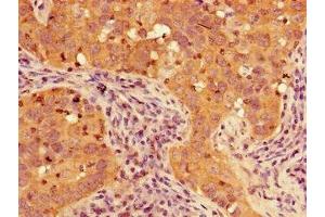 Immunohistochemistry of paraffin-embedded human pancreatic cancer using ABIN7153207 at dilution of 1:100