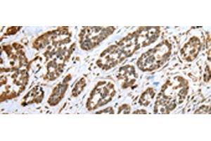 Immunohistochemistry of paraffin-embedded Human esophagus cancer tissue using CNPY2 Polyclonal Antibody at dilution of 1:25(x200) (CNPY2/MSAP 抗体)