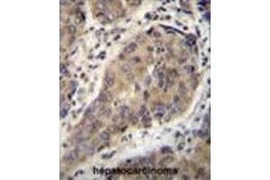WTIP Antibody (C-term) immunohistochemistry analysis in formalin fixed and paraffin embedded human hepatocarcinoma followed by peroxidase conjugation of the secondary antibody and DAB staining. (WTIP 抗体  (C-Term))
