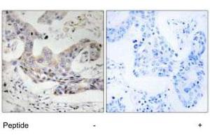 Immunohistochemistry analysis of paraffin-embedded human breast carcinoma tissue, using ALDH3B1 polyclonal antibody . (ALDH3B1 抗体)
