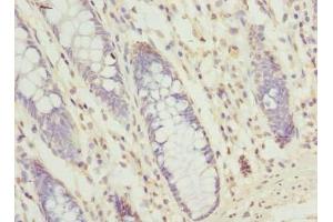 Immunohistochemistry of paraffin-embedded human colon cancer using ABIN7166217 at dilution of 1:100 (SEC61G 抗体  (AA 1-32))