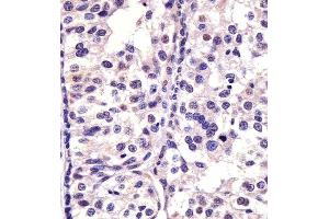 Paraformaldehyde-fixed, paraffin embedded human breast carcinoma, Antigen retrieval by boiling in sodium citrate buffer (pH6. (CDK4 抗体)