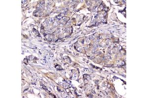 IHC testing of FFPE human breast cancer tissue with Dynamin 1 antibody at 1ug/ml.
