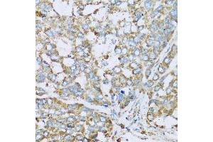 Immunohistochemistry of paraffin-embedded human liver cancer using COX6A1 antibody. (COX6A1 抗体  (AA 25-109))
