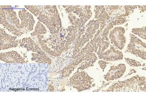Immunohistochemical analysis of paraffin-embedded human liver cancer tissue.