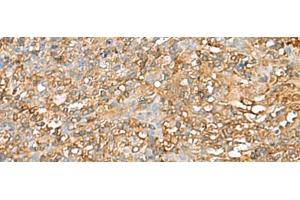 Immunohistochemistry of paraffin-embedded Human tonsil tissue using LGALS9 Polyclonal Antibody at dilution of 1:40(x200) (Galectin 9 抗体)
