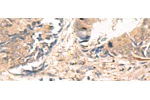 Immunohistochemistry of paraffin-embedded Human colorectal cancer tissue using ABHD2 Polyclonal Antibody at dilution of 1:40(x200) (ABHD2 抗体)