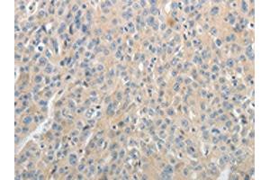 The image on the left is immunohistochemistry of paraffin-embedded Human ovarian cancer tissue using ABIN7189581(ABCB11 Antibody) at dilution 1/25, on the right is treated with synthetic peptide. (ABCB11 抗体)