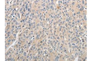 The image on the left is immunohistochemistry of paraffin-embedded Human ovarian cancer tissue using ABIN7189581(ABCB11 Antibody) at dilution 1/25, on the right is treated with synthetic peptide.