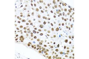 Immunohistochemistry of paraffin-embedded human lung cancer using METTL3 antibody (ABIN5974672) at dilution of 1/100 (40x lens). (METTL3 抗体)