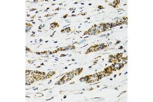 Immunohistochemistry of paraffin-embedded human breast cancer using HSPA9 antibody. (HSPA9 抗体  (AA 380-679))