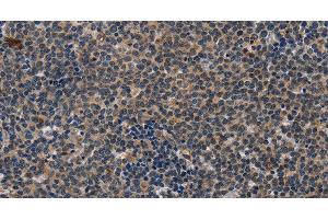 Immunohistochemistry of paraffin-embedded Human lymphoma tissue using CD47 Polyclonal Antibody at dilution 1:50 (CD47 抗体)