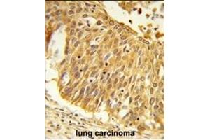 Formalin-fixed and paraffin-embedded human lung carcinoma reacted with EEFSEC Antibody (C-term), which was peroxidase-conjugated to the secondary antibody, followed by DAB staining. (EEFSEC 抗体  (C-Term))