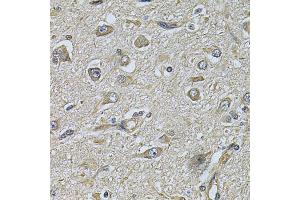 Immunohistochemistry of paraffin-embedded human brain cancer using WIPI1 Antibody. (WIPI1 抗体)
