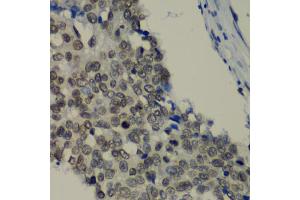 Immunohistochemistry of paraffin-embedded human lung cancer using TEAD1 antibody (ABIN6291475) at dilution of 1:100 (40x lens). (TEAD1 抗体)