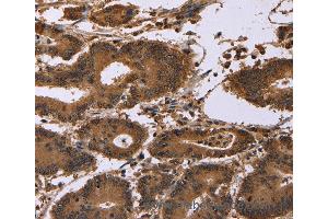 Immunohistochemistry of Human colon cancer using EDN2 Polyclonal Antibody at dilution of 1:30 (Endothelin 2 抗体)