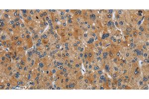 Immunohistochemistry of paraffin-embedded Human liver cancer tissue using FLCN Polyclonal Antibody at dilution 1:40 (FLCN 抗体)