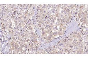 ABIN6273316 at 1/100 staining Human thyroid cancer tissue by IHC-P. (Seladin 1 抗体  (N-Term))