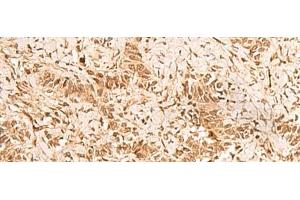 Immunohistochemistry of paraffin-embedded Human ovarian cancer tissue using HOXC12 Polyclonal Antibody at dilution of 1:50(x200) (HOXC12 抗体)
