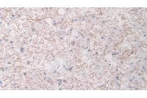 Detection of ELA1 in Human Glioma Tissue using Polyclonal Antibody to Pancreatic Elastase 1 (ELA1)