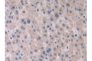 DAB staining on IHC-P; Samples: Human Liver cancer Tissue (PAFAH2 抗体  (AA 1-392))