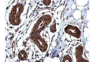 IHC-P Image ROCK1 antibody [N1N2], N-term detects ROCK1 protein at cytoplasm on human breast carcinoma by immunohistochemical analysis. (ROCK1 抗体  (N-Term))