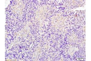 Formalin-fixed and paraffin embedded human glioma tissue labeled with Anti-JUP/Cateninma γ Polyclonal Antibody, Unconjugated at 1:200 followed by conjugation to the secondary antibody and DAB staining (JUP 抗体  (AA 601-700))