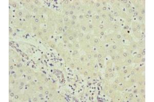 Immunohistochemistry of paraffin-embedded human liver cancer using ABIN7151202 at dilution of 1:100 (RNF5 抗体  (AA 1-120))