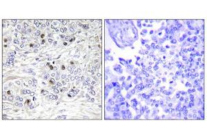 Immunohistochemistry analysis of paraffin-embedded human breast carcinoma tissue, using TEAD2 antibody. (TEAD2 抗体  (Internal Region))