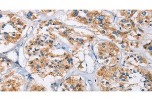 Immunohistochemistry of paraffin-embedded Human thyroid cancer using Cathepsin L Polyclonal Antibody at dilution of 1:40 (Cathepsin L 抗体)