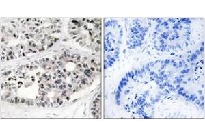 Immunohistochemistry analysis of paraffin-embedded human lung carcinoma tissue, using Collagen VII alpha1 Antibody. (COL7A1 抗体  (AA 1841-1890))