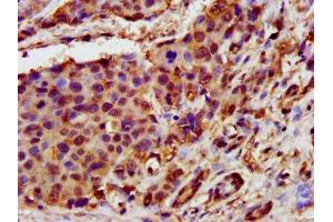 IHC image of ABIN7154521 diluted at 1:400 and staining in paraffin-embedded human pancreatic cancer performed on a Leica BondTM system. (GHITM 抗体  (AA 293-345))