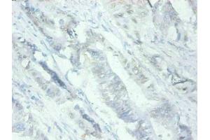 Immunohistochemical of paraffin-embedded human Colon cancer tissues using ABIN7159679 at dilution of 1:200 (MFGE8 抗体)