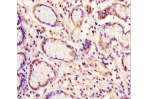 Immunohistochemistry of paraffin-embedded human gastric cancer using ABIN7152221 at dilution of 1:100 (EIF6 抗体  (AA 1-245))