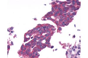 Anti-GPRC6A antibody IHC of human Ovary, Carcinoma. (GPRC6A 抗体  (N-Term))