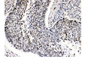 Emerin was detected in paraffin-embedded sections of human lung cancer tissues using rabbit anti- Emerin Antigen Affinity purified polyclonal antibody (Catalog # ) at 1 µg/mL. (Emerin 抗体  (N-Term))