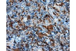 Immunohistochemical staining of paraffin-embedded Adenocarcinoma of colon tissue using anti-RC219453 mouse monoclonal antibody. (NPR3 抗体)