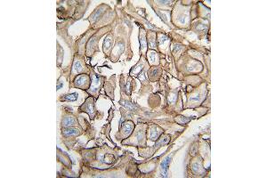 Formalin-fixed and paraffin-embedded human lung carcinoma tissue reacted with HRAS antibody , which was peroxidase-conjugated to the secondary antibody, followed by DAB staining. (HRAS 抗体  (AA 104-128))