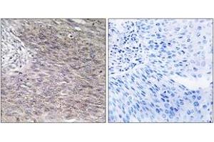 Immunohistochemistry analysis of paraffin-embedded human cervix carcinoma tissue, using CHSY2 Antibody. (CHPF 抗体  (AA 631-680))