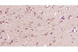 Paraformaldehyde-fixed, paraffin embedded human glioma, Antigen retrieval by boiling in sodium citrate buffer (pH6) for 15min, Block endogenous peroxidase by 3% hydrogen peroxide for 30 minutes, Blocking buffer (normal goat serum) at 37°C for 20min, Antibody incubation with 14-3-3 beta Polyclonal Antibody, Unconjugated  at 1:400 overnight at 4°C, followed by a conjugated secondary and DAB staining. (YWHAB 抗体  (AA 51-150))