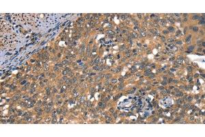 Immunohistochemistry of paraffin-embedded Human cervical cancer using DAAM1 Polyclonal Antibody at dilution of 1:50 (DAAM1 抗体)